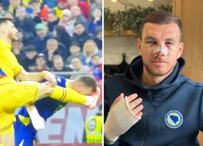 📸 Dzeko si rompe il naso: Nainggolan e Balotelli ridono sui social 🤣